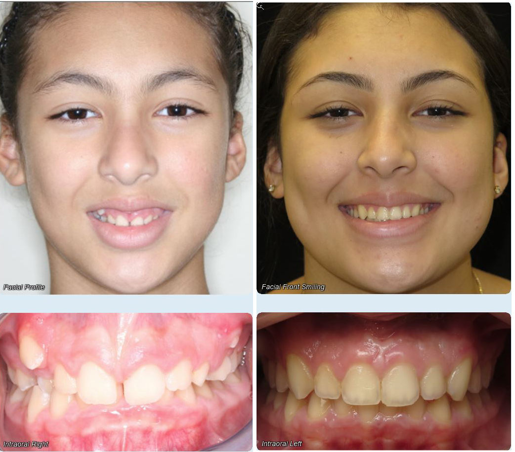 Before and After - Rodriguez Orthodontics